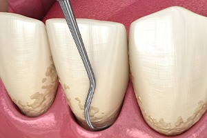 Illustration of the scaling and root planing process