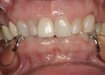 Closeup of unhealthy discolored smile