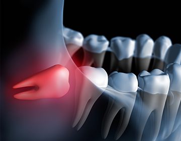 Animation of impacted wisdom tooth