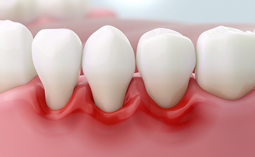 Illustration of red, inflamed gums