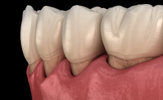 Illustration of gum recession