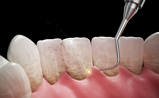 Illustration of dental tool cleaning a patient's teeth