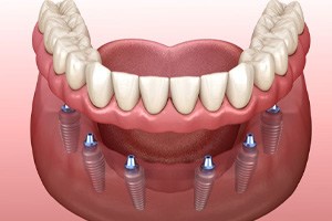 Illustration of implant denture for lower arch