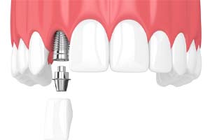 single dental implant with crown in upper arch