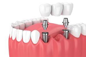 two dental implants supporting a dental bridge