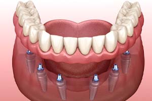 six dental implants supporting a full denture