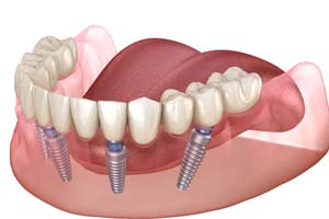 All-on-4 implant denture on lower arch