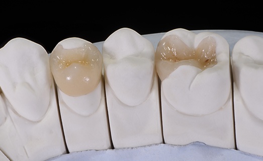 Model smile with inlay and onlay restorations