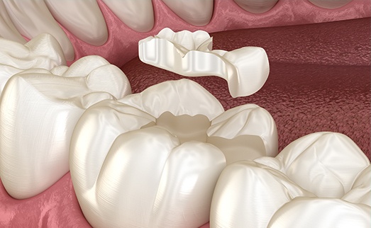 Animation of dental inlay process