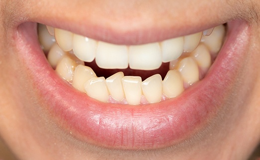 A close-up of a man’s crooked smile 